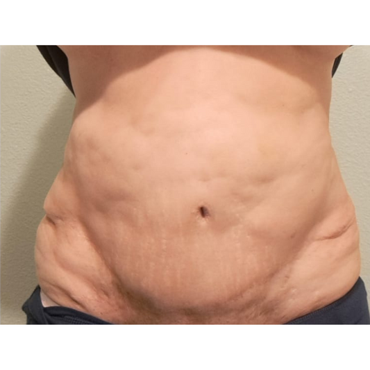 Fibrosis Post Quirúrgica y su Manejo Revolucionario con Mesoterapia